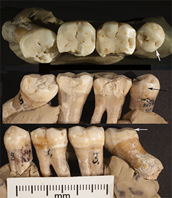 Three views of the four teeth recovered from the Neanderthal Krapina site in Croatia, roughly 130,000 years old. A team of researchers led by David Frayer, KU professor emeritus of anthropology, examined the teeth and found evidence of scratches and toothpick grooves on the three molars and one premolar tooth from the bottom left side of the Neanderthal’s mouth. Because two of the teeth are pushed out of their normal positions, the researchers found the grooves indicate an effort by the Neanderthal to manipulate his or her teeth to relieve the pain.